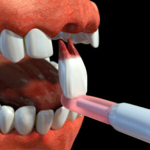 Tooth – Extracting Implement